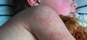 В Одесской области зафиксировали вспышку кори: все больные – дети